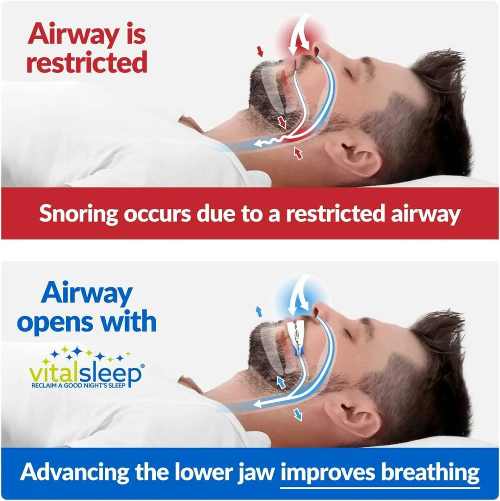 Stop Snoring Mouthpiece with VitalSleep | Anti Snoring Device